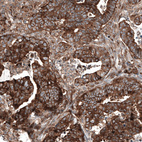 Immunohistochemical staining of human colorectal cancer shows strong cytoplasmic positivity in tumor cells.