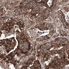 Immunohistochemical staining of human colorectal cancer shows strong cytoplasmic positivity in tumor cells.