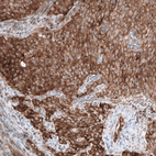 Immunohistochemical staining of human cervical cancer shows strong cytoplasmic positivity in tumor cells.