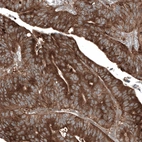 Immunohistochemical staining of human colorectal cancer (metastasis to ovary) shows strong cytoplasmic positivity in tumor cells.