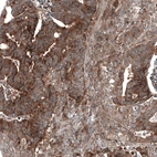 Immunohistochemical staining of human colorectal cancer shows moderate to strong cytoplasmic positivity in tumor cells.