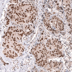 Immunohistochemical staining of human breast cancer (ductal carcinoma) shows strong nuclear positivity in tumor cells.