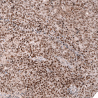 Immunohistochemical staining of human endometrial cancer shows strong nuclear positivity in tumor cells.