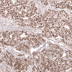 Immunohistochemical staining of human ovarian cancer (high grade serous ovarian carcinoma) shows strong nuclear positivity in tumor cells.