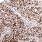 Immunohistochemical staining of human ovarian cancer (high grade serous ovarian carcinoma) shows strong nuclear positivity in tumor cells.