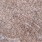 Immunohistochemical staining of human endometrial cancer shows moderate nuclear positivity in tumor cells.