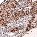 Immunohistochemical staining of human ovarian cancer (papillary carcinoma) shows strong nuclear positivity in tumor cells.