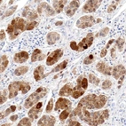 Immunohistochemical staining of human liver cancer shows moderate to strong cytoplasmic positivity in tumor cells.