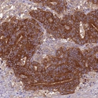 Immunohistochemical staining of human colorectal cancer shows strong cytoplasmic positivity in tumor cells.