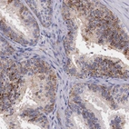 Immunohistochemical staining of human prostate shows modarate granular cytoplasmic positivity in glandular cells.