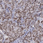 Immunohistochemical staining of human colorectal cancer shows strong nuclear positivity in tumor cells.