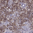 Immunohistochemical staining of human testis cancer shows strong cytoplasmic and nuclear positivity in tumor cells.