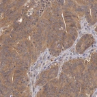 Immunohistochemical staining of human colorectal cancer shows moderate cytoplasmic positivity in tumor cells.