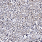 Immunohistochemical staining of human HER2 negative breast cancer shows no positivity in tumor cells as expected.