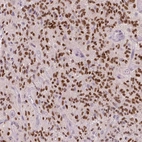 Immunohistochemical staining of human glioma shows moderate to strong nuclear positivity in tumor cells.