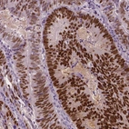 Immunohistochemical staining of human colorectal cancer shows moderate to strong nuclear positivity in tumor cells.