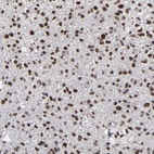 Immunohistochemical staining of human glioma shows moderate to strong nuclear positivity in tumor cells.