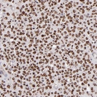 Immunohistochemical staining of human glioma shows moderate to strong nuclear positivity in tumor cells.