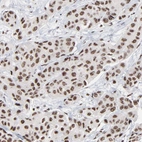 Immunohistochemical staining of human breast cancer shows moderate to strong nuclear positivity in tumor cells.