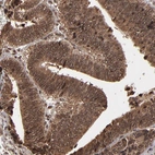 Immunohistochemical staining of human colorectal cancer shows strong positivity in tumor cells.
