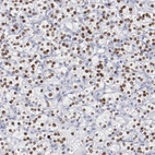 Immunohistochemical staining of human renal cancer shows moderate to strong nuclear positivity in tumor cells.