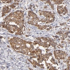 Immunohistochemical staining of human breast cancer shows strong cytoplasmic positivity in tumor cells.