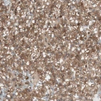 Immunohistochemical staining of human renal cancer shows moderate membranous positivity in tumor cells.