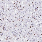Immunohistochemical staining of human glioma shows moderate nuclear positivity in tumor cells.