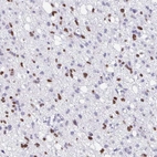Immunohistochemical staining of human glioma shows moderate nuclear positivity in tumor cells.