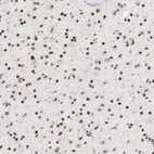 Immunohistochemical staining of human glioma shows strong nuclear positivity in tumor cells.
