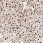 Immunohistochemical staining of human glioma shows strong nuclear positivity in tumor cells.