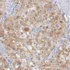 Immunohistochemical staining of human hepatocellular carcinoma shows moderate cytoplasmic and nuclear positivity in tumor cells.