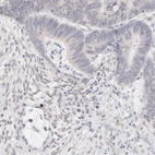 Immunohistochemical staining of human colorectal cancer shows weak nuclear positivity in tumor cells.