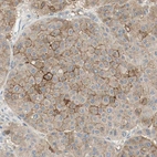 Immunohistochemical staining of human malignant melanoma shows moderate membranous positivity in tumor cells.