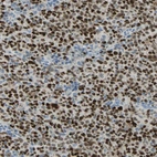 Immunohistochemical staining of human lymphoma, non-Hodgkin's type, shows strong nuclear positivity in tumor cells.