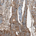 Immunohistochemical staining of human colorectal cancer shows moderate positivity.