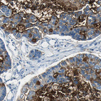 Immunohistochemical staining of human lung cancer, adenocarcinoma shows moderate cytoplasmic positivity in tumor cells.