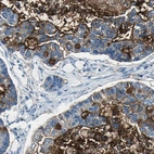 Immunohistochemical staining of human lung cancer, adenocarcinoma shows moderate cytoplasmic positivity in tumor cells.