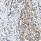 Immunohistochemical staining of human breast cancer shows moderate membranous positivity in tumor cells.