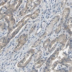 Immunohistochemical staining of human prostate cancer shows moderate membranous positivity in tumor cells.