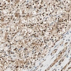 Immunohistochemical staining of human renal cancer shows strong nuclear positivity in tumor cells.