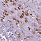 Immunohistochemical staining of human placenta shows moderate cytoplasmic positivity in extravillous trophoblastic cells.
