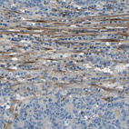 Immunohistochemical staining of human colorectal cancer shows weak to moderate cytoplasmic positivity in stromal cells.