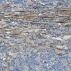 Immunohistochemical staining of human colorectal cancer shows weak to moderate cytoplasmic positivity in stromal cells.