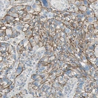 Immunohistochemical staining of human lung cancer shows strong membranous positivity in tumor cells.