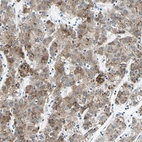 Immunohistochemical staining of human liver cancer shows moderate cytoplasmic positivity in tumor cells.