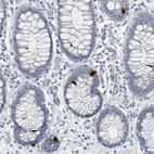 Immunohistochemical staining of human colon shows strong cytoplasmic positivity in enteroendocrine cells.