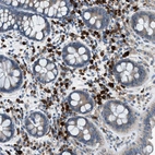 Immunohistochemical staining of human colon shows strong membranous and cytoplasmic positivity in lymphoid cells.