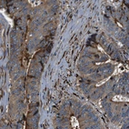 Immunohistochemical staining of human colorectal cancer shows strong strong positivity in tumor cells.