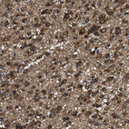 Immunohistochemical staining of human glioma shows moderate to strong cytoplasmic positivity in tumor cells.